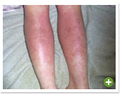 脱ステロイド 改善日記
2010年2月7日
離脱症状の初めての大きな波