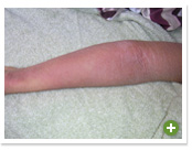 脱ステロイド 改善日記
2010年2月7日
離脱症状の初めての大きな波