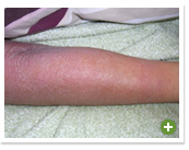 脱ステロイド 改善日記
2010年2月7日
離脱症状の初めての大きな波