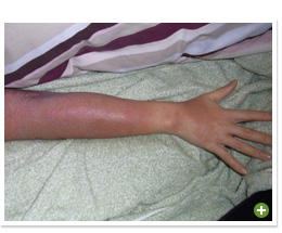 脱ステロイド 改善日記
2010年2月12日