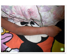 脱ステロイド 改善日記
2010年2月17日