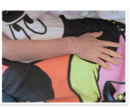 脱ステロイド 改善日記
2010年2月24日