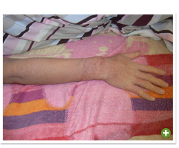 脱ステロイド 改善日記
2010年3月3日