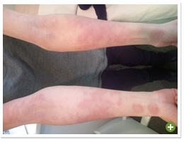 脱ステロイド 改善日記
2009年12月28日
初めてのご相談